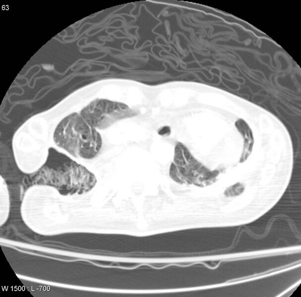 File:Clagett thoracotomy (Radiopaedia 8568-9403 Axial lung window 5).jpg