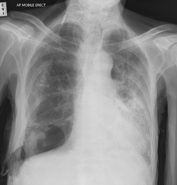 File:Clagett thoracotomy with bronchopleural fistula (Radiopaedia 29192-29586 Frontal 1).jpg