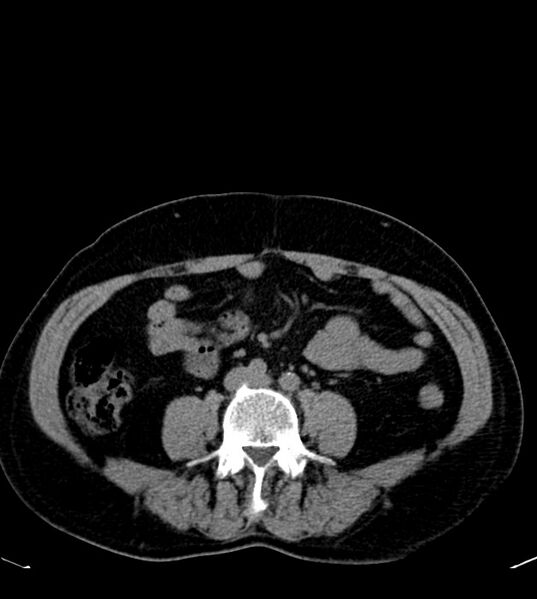 File:Clear cell renal cell carcinoma (Radiopaedia 85006-100539 Axial non-contrast 53).jpg