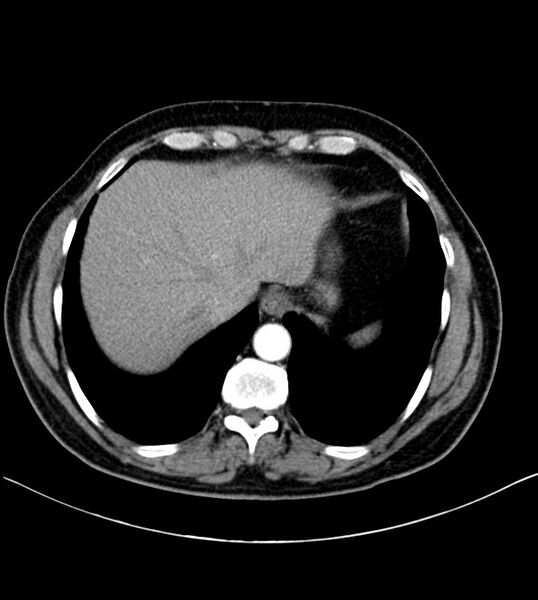 File:Clear cell renal cell carcinoma (Radiopaedia 85006-100539 B 17).jpg
