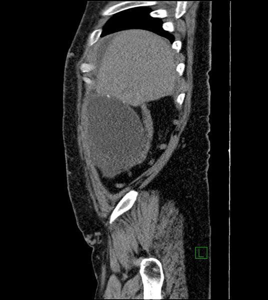 File:Closed-loop small bowel obstruction-internal hernia (Radiopaedia 78439-91096 C 122).jpg