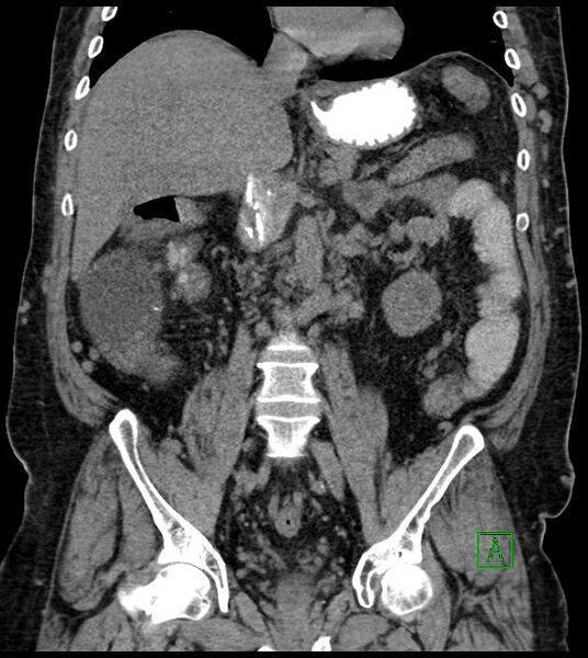 File:Closed-loop small bowel obstruction-internal hernia (Radiopaedia 78439-91096 Coronal non-contrast 57).jpg