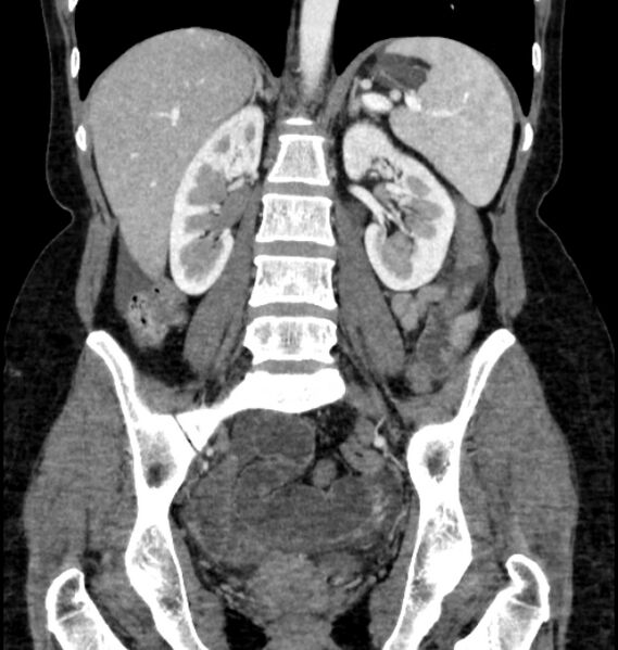 File:Closed loop small bowel obstruction (Radiopaedia 71211-81508 B 79).jpg