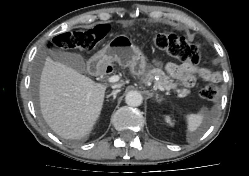 File:Closed loop small bowel obstruction with ischemia (Radiopaedia 84180-99456 A 28).jpg