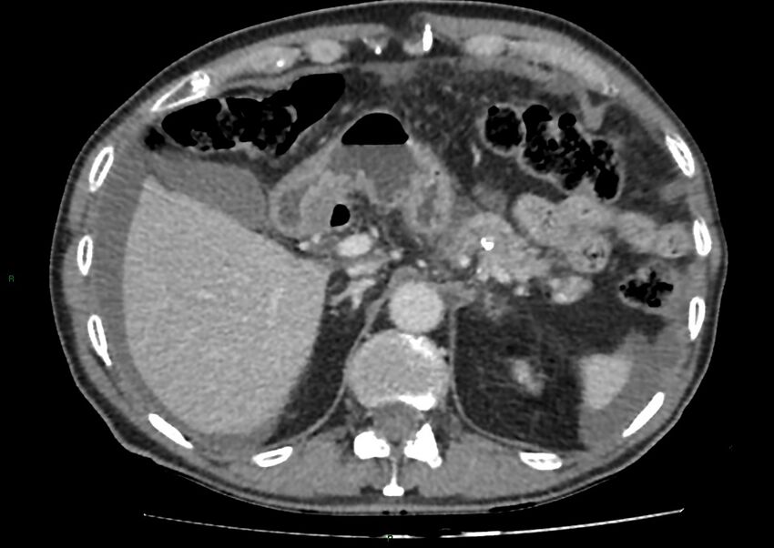 Closed loop small bowel obstruction with ischemia (Radiopaedia 84180-99456 A 28).jpg