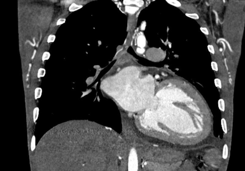 File:Coarctation of aorta with aortic valve stenosis (Radiopaedia 70463-80574 C 139).jpg