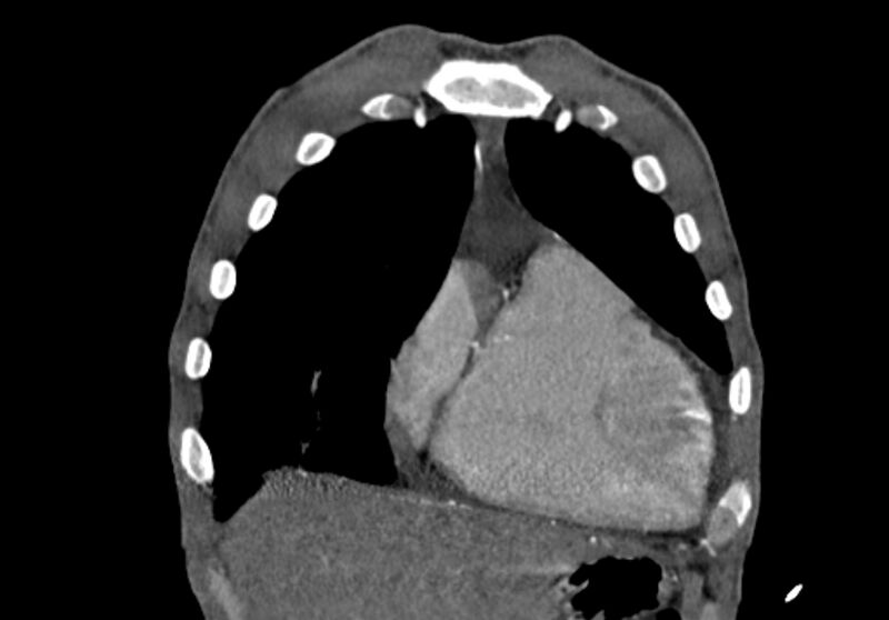 File:Coarctation of aorta with aortic valve stenosis (Radiopaedia 70463-80574 C 29).jpg