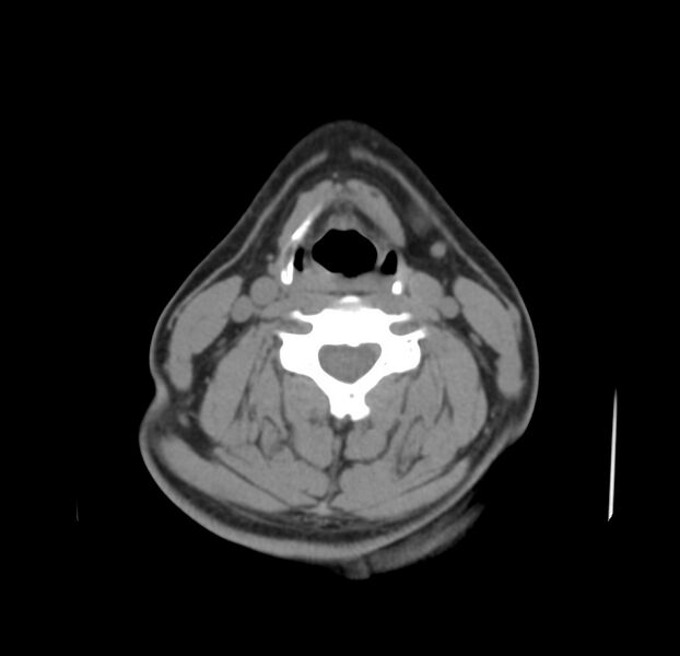 File:Colloid cyst of thyroid (Radiopaedia 22897-22923 Axial non-contrast 28).jpg