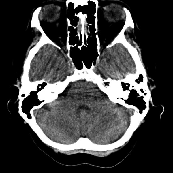 File:Colloid cyst with hydrocephalus (Radiopaedia 9373-10064 Axial non-contrast 5).jpg