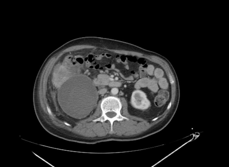 File:Colon cancer mimicking renal cell carcinoma (Radiopaedia 28986-29335 C 34).jpg