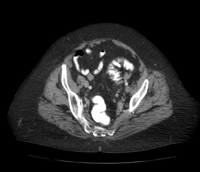 File:Colonic diverticulosis (Radiopaedia 22934-22957 A 60).jpg