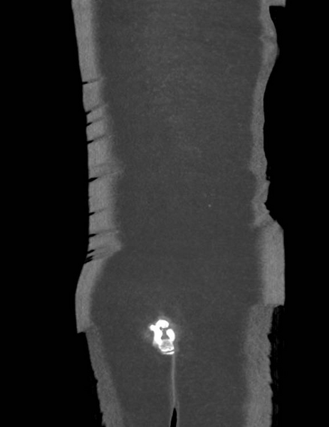 File:Colonic pseudo-obstruction (Radiopaedia 79752-92980 B 57).png