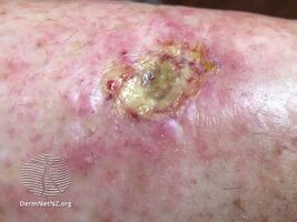 Hydroxyurea-induced leg ulcer