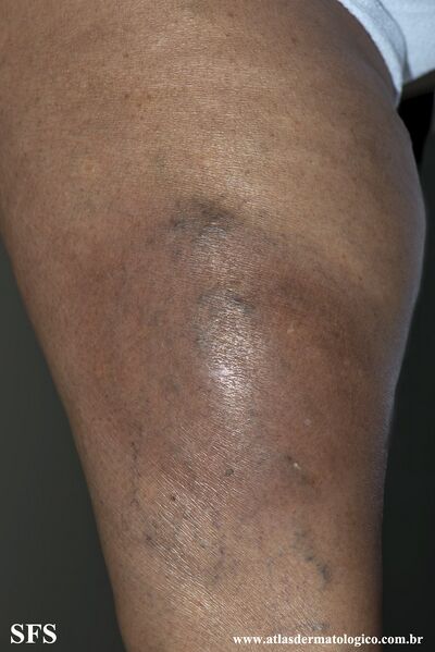 File:Lipodermatosclerosis (Dermatology Atlas 2).jpg