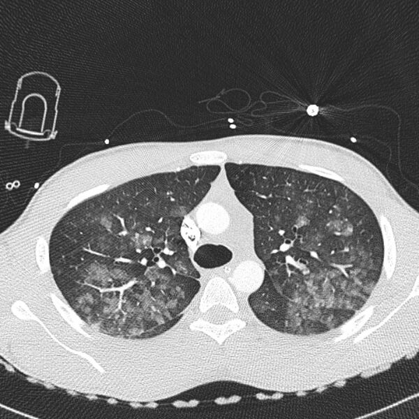 File:Near drowning (pulmonary edema) (Radiopaedia 24685-24958 lung window 6).jpg