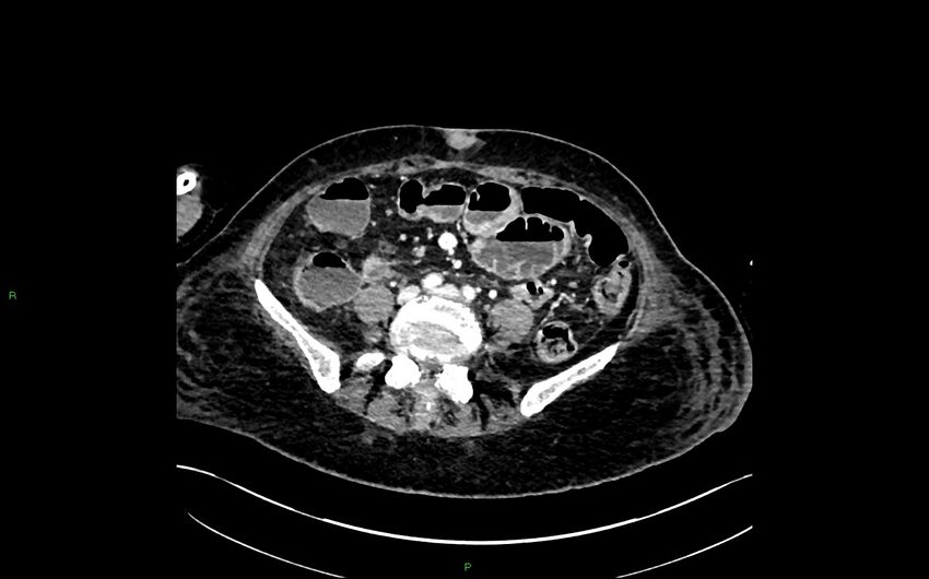 Neo-terminal ileal stricture (Crohn disease) (Radiopaedia 33790-34948 A 286).jpg