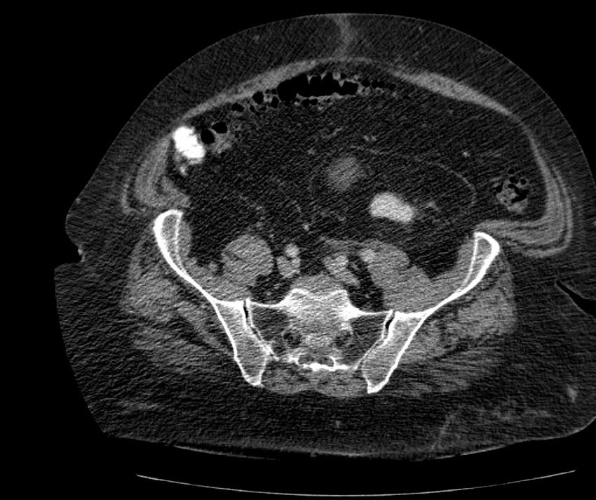 Nephroptosis with inguinal hernia containing perirenal fat (Radiopaedia 56632-63391 C 257).jpg
