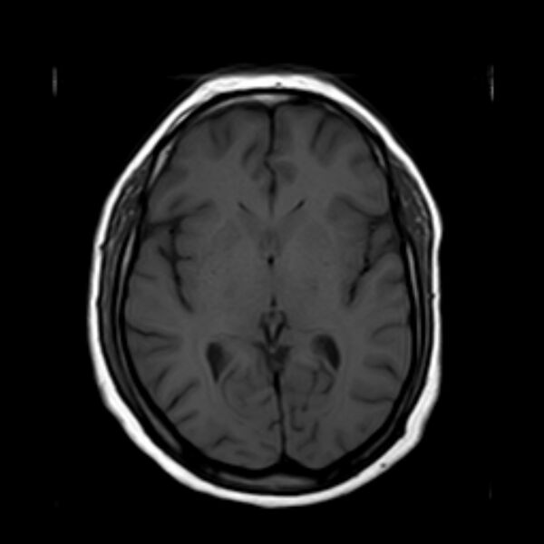 File:Neurofibromatosis type 2 (Radiopaedia 67470-76871 Axial T1 12).jpg