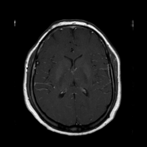 File:Neurofibromatosis type 2 (Radiopaedia 67470-76871 Axial T1 C+ 14).jpg