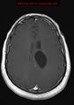 Neuroglial cyst (Radiopaedia 10713-11184 Axial T1 C+ 9).jpg