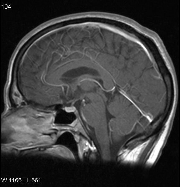 File:Neurosarcoidosis (Radiopaedia 10930-17204 Sagittal T1 C+ 9).jpg