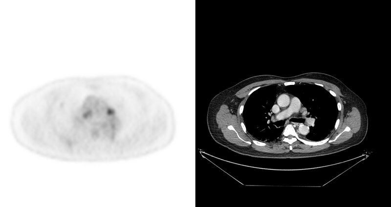 File:Non-Hodgkin lymphoma involving seminal vesicles with development of interstitial pneumonitis during Rituximab therapy (Radiopaedia 32703-33675 axial PET CT 49).jpg