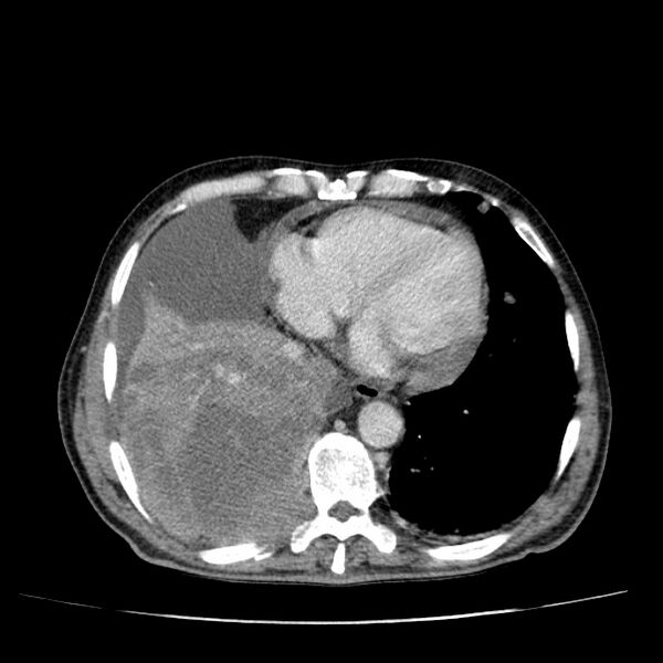 File:Non small-cell lung cancer (Radiopaedia 24467-24769 C+ delayed 44).jpg