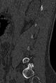 Normal CT lumbar spine (Radiopaedia 53981-60118 Sagittal bone window 15).jpg