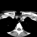 Normal CT of the neck (Radiopaedia 14575-14500 Axial C+ 68).jpg