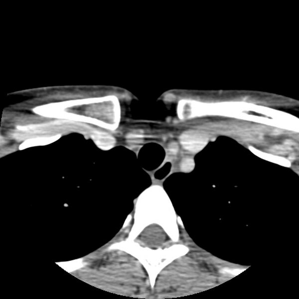 File:Normal CT of the neck (Radiopaedia 14575-14500 Axial C+ 68).jpg