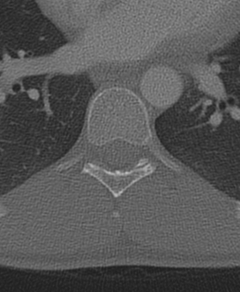 File:Normal CT thoracic spine (Radiopaedia 40181-42688 Axial bone window 57).png