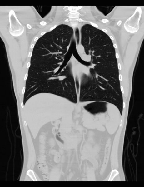 File:Normal CT virtual gastroscopy (Radiopaedia 29960-30501 F 4).jpg