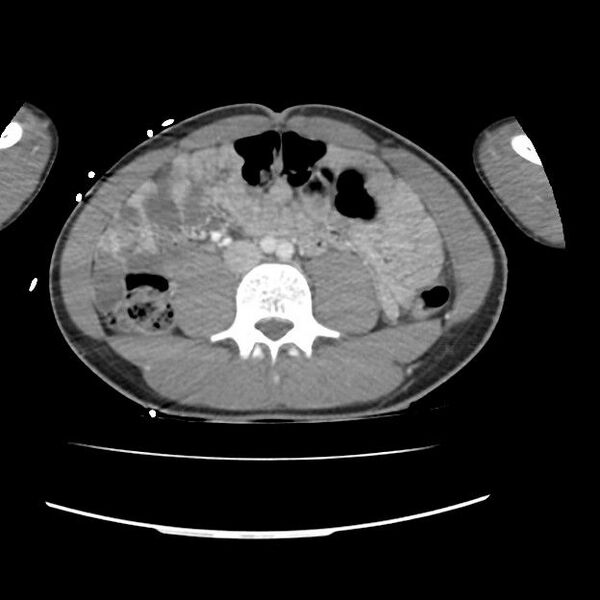 File:Normal dual-phase trauma CT chest,abdomen and pelvis (Radiopaedia 48092-52899 A 79).jpg