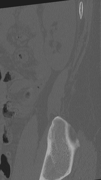 File:Normal lumbar spine CT (Radiopaedia 46533-50986 Sagittal bone window 4).png