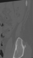 Normal lumbar spine CT (Radiopaedia 46533-50986 Sagittal bone window 4).png