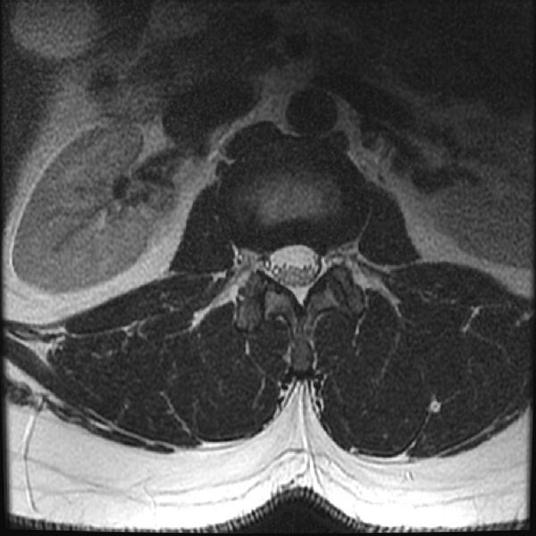 File:Normal lumbar spine MRI (Radiopaedia 43051-46311 Axial T2 4).jpg