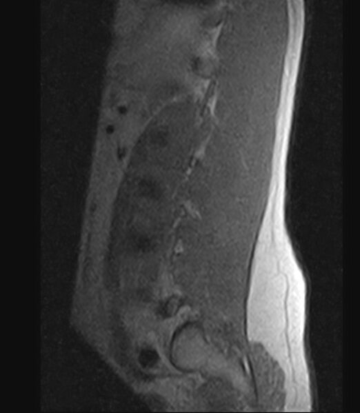 File:Normal lumbar spine MRI - low-field MRI scanner (Radiopaedia 40976-43699 Sagittal T1 11).jpg