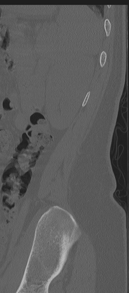 File:Normal lumbosacral CT (Radiopaedia 37923-39867 Sagittal bone window 6).png