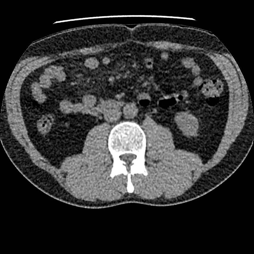 Obstructing ureteric calculus and ureteric anatomy (Radiopaedia 62730-71042 Axial non-contrast 62).jpg