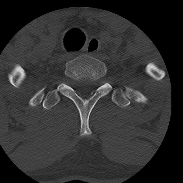 File:Occipital condyle fracture (Radiopaedia 31755-32691 Axial bone window 80).jpg