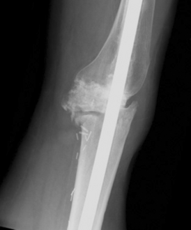 Individual with tumoral calcinosis- Lateral radiograph of the left knee demonstrating an intramedullary rod