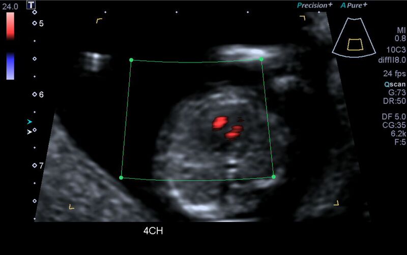 File:1st trimester nuchal-morphology ultrasound (Radiopaedia 44706-48477 Heart views cine with colour 18).jpg