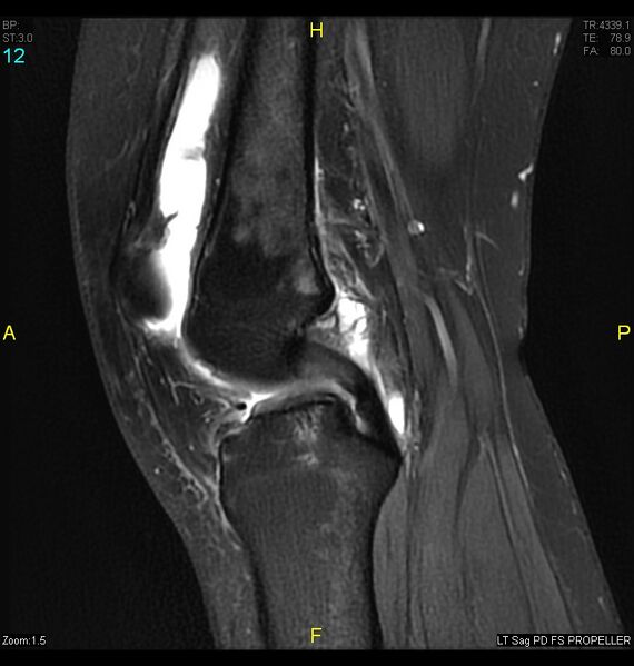 File:ACL mucoid degeration with cystic changes (Radiopaedia 48428-53341 Sagittal PD fat sat 10).jpg