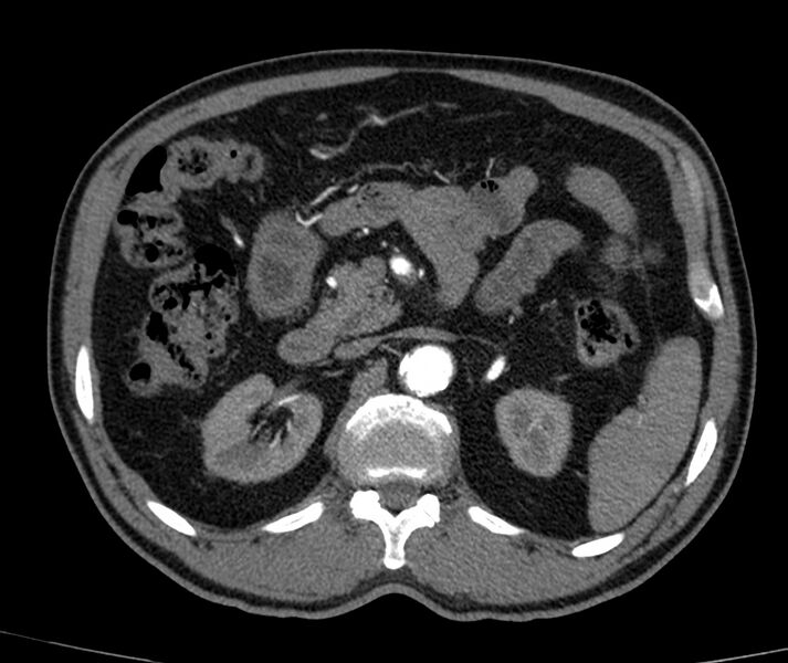 File:Abdominal aortic aneurysm (Radiopaedia 22421-22458 C+ arterial phase 24).jpg