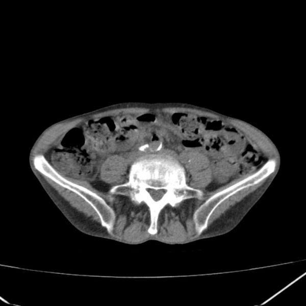 File:Abdominal aortic aneurysm (Radiopaedia 23703-23856 Axial non-contrast 36).jpg