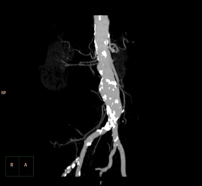 File:Abdominal aortic aneurysm (Radiopaedia 23703-23856 MIP 4).jpg