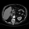 Abdominal aortic aneurysm (Radiopaedia 25855-26001 Axial C+ arterial phase 43).jpg