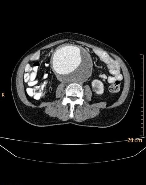 File:Abdominal aortic aneurysm (Radiopaedia 25985-26121 Axial C+ arterial phase 20).jpg