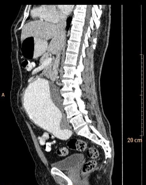 File:Abdominal aortic aneurysm (Radiopaedia 25985-26121 Sagittal C+ arterial phase 20).jpg
