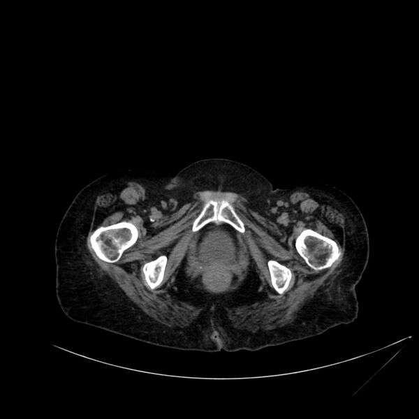 File:Abdominal aortic aneurysm - impending rupture (Radiopaedia 19233-19246 Axial non-contrast 129).jpg